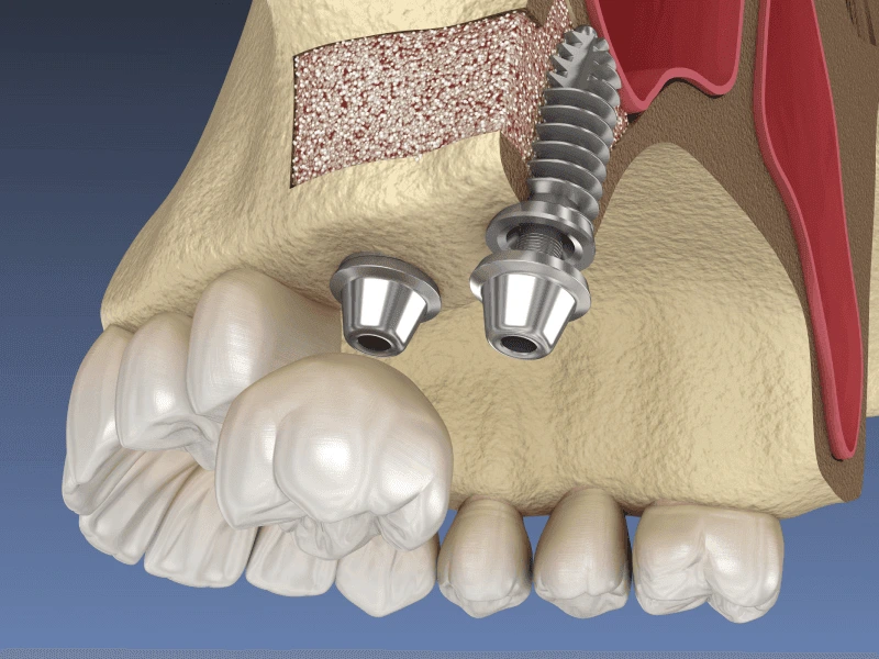 SINUS Lift by Access Oral Surgery in Summerville SC