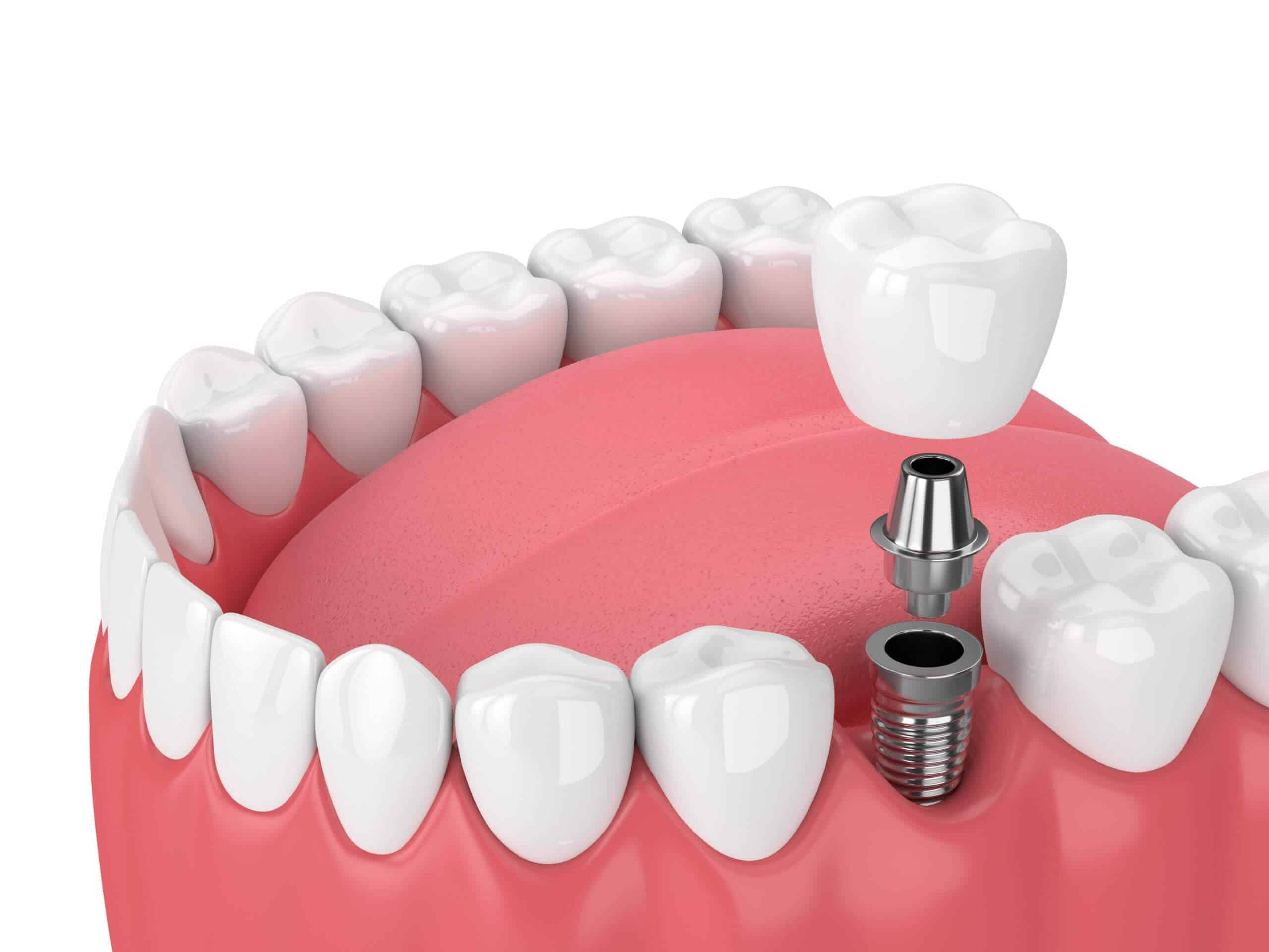 What are the Benefits of Dental Implants