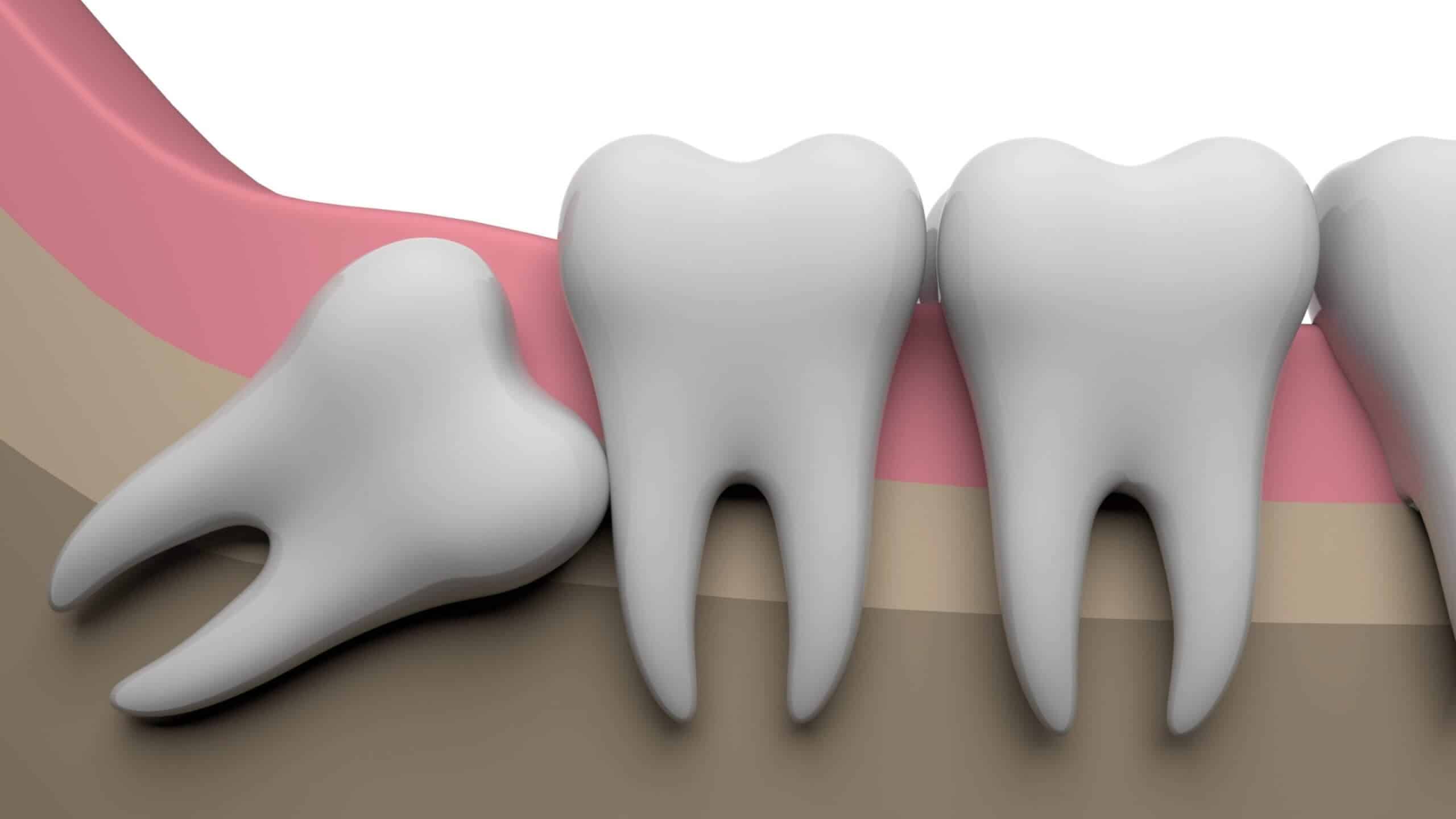 The Ultimate Guide to Wisdom Teeth Causes Symptoms Extraction and Recovery