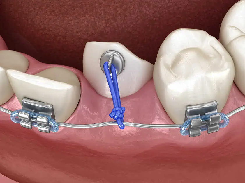 Impacted Canines by Access Oral Surgery in Summerville, SC