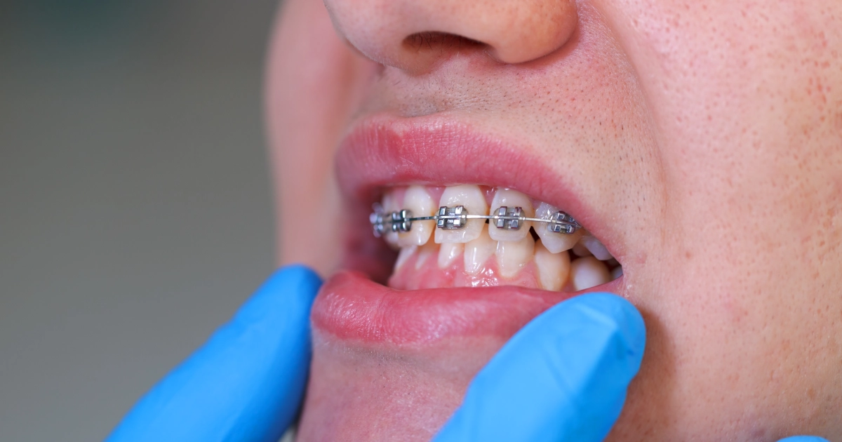 Close-up of mouth with braces, showing impacted canine treatment in Summerville, SC