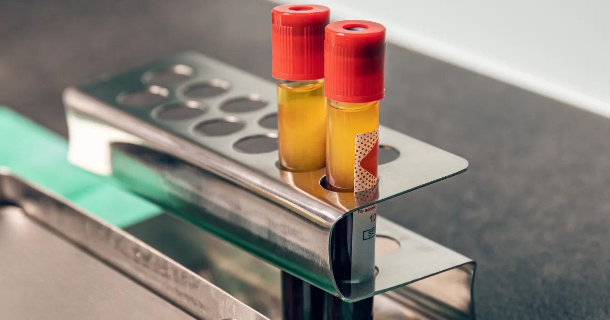 Platelet Rich Fibrin (PRF) In Summerville, SC for Bone Regeneration in Implant Dentistry