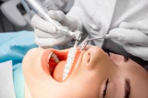 Teeth Cleaning | Access Oral Surgery | Sangaree & Mt. Pleasant, SC
