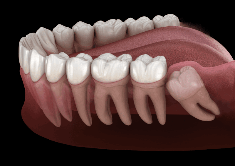 Wisdom Teeth | Access Oral Surgery | Sangaree & Mt. Pleasant, SC
