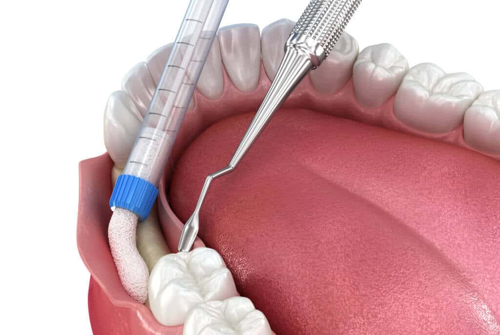 Bone grafting | Access Oral Surgery | Summerville, SC