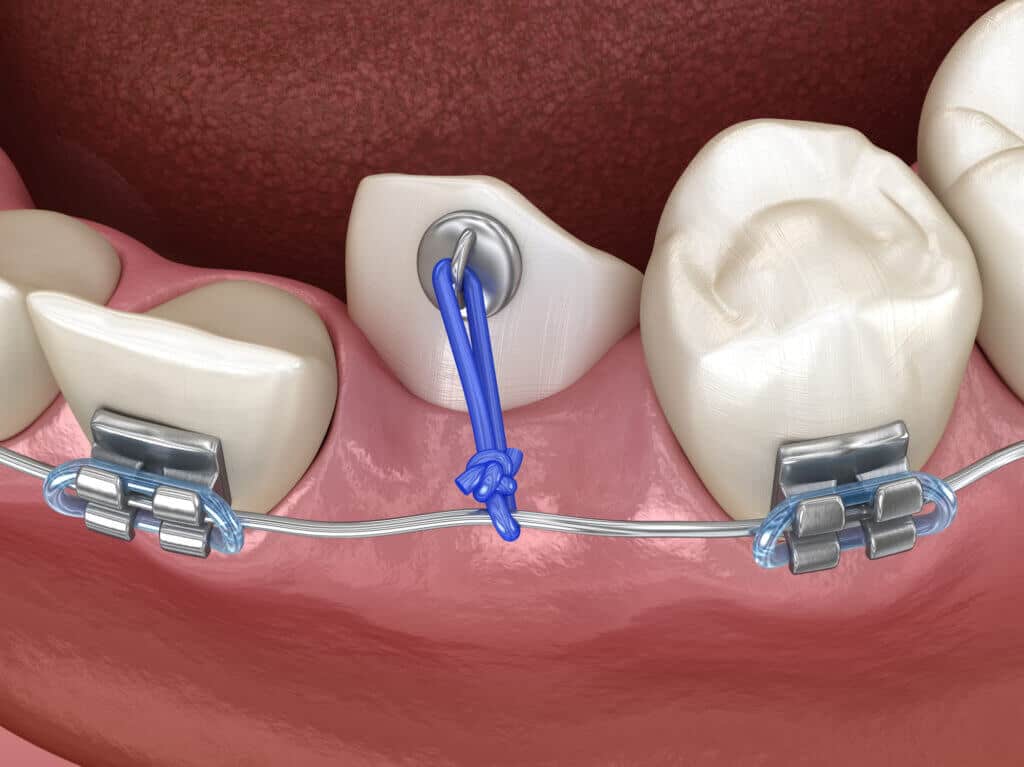 Impacted Canines | Access Oral Surgery | Summerville, SC