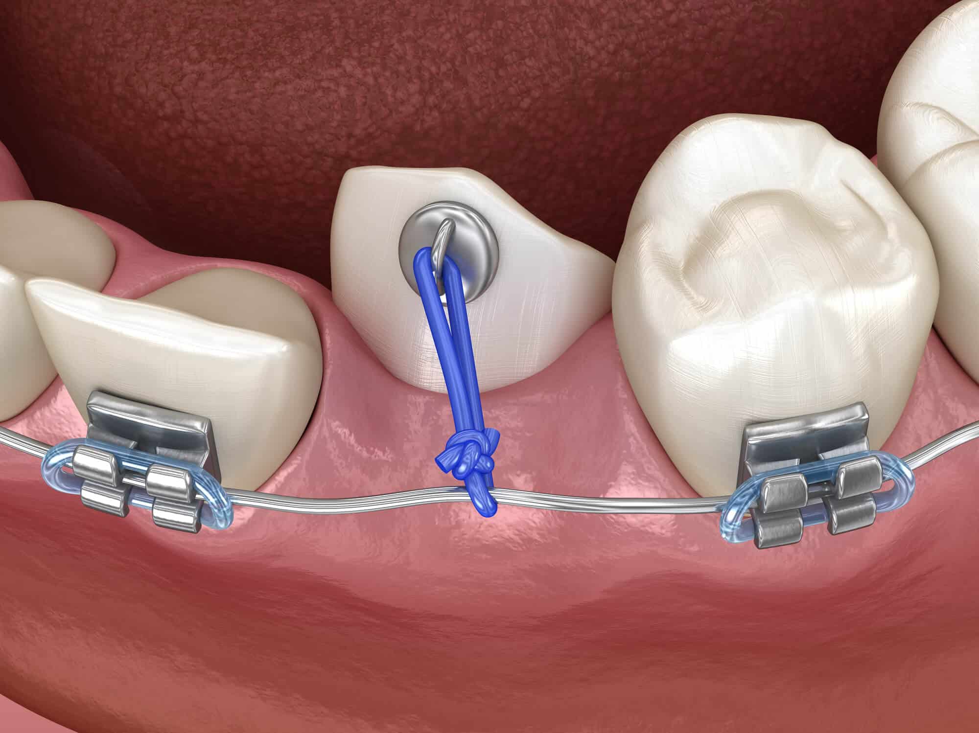 Impacted Canines | Access Oral Surgery | Summerville, SC
